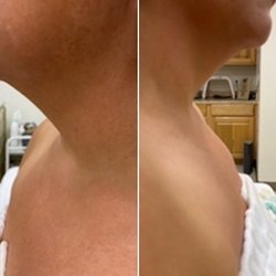 Luzskincare Spa - Double chin reduction