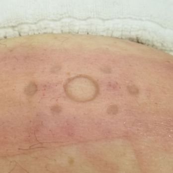 Lifestyle With Joy - This is what it looked like afterwards... it didnt hurt at all... but it was coooolllllddd!!!! The bruising faded after awhile... - Body Contouring Near Me - Bakersfield, California