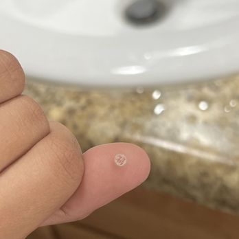 X Nails - Wart from unsanitary salon - Nail Salons Near Me - Lewisville, Texas X Nails - Wart from unsanitary salon - Nail Salons Near Me - Lewisville, Texas