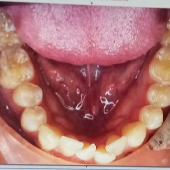 Mario E Tai, DMD DMSc - Before aligners - Orthodontists Near Me - Irvine, California