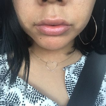InjectAbility Clinic - One day after - Skin Care Near Me - Torrance, California InjectAbility Clinic - One day after - Skin Care Near Me - Torrance, California