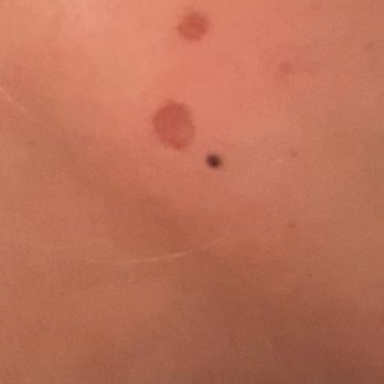 Zen Spa Aesthetics - Close up of burns on my face caused by Zen's Pumpkin Refresh. - Permanent Makeup Near Me - Torrance, California Zen Spa Aesthetics - Close up of burns on my face caused by Zen's Pumpkin Refresh. - Permanent Makeup Near Me - Torrance, California