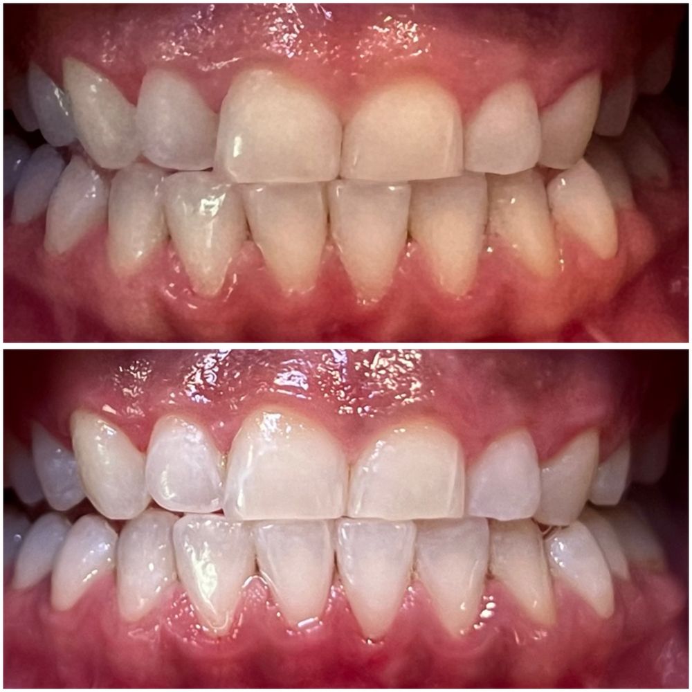 Deebeaut - Before / After - Teeth Whitening Near Me Deebeaut - Before / After - Teeth Whitening Near Me