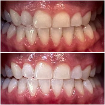 Deebeaut - Before / After - Teeth Whitening Near Me