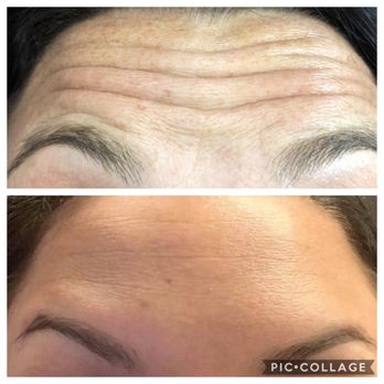 Beyond Brows - Bye bye wrinkles with Botox - Permanent Makeup Near Me - Willow Park, Texas Beyond Brows - Bye bye wrinkles with Botox - Permanent Makeup Near Me - Willow Park, Texas