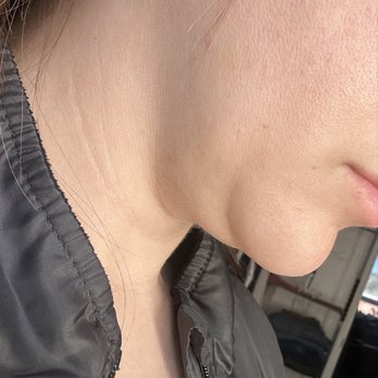 David H. Gilbert DDS, MS, MBA, FACS - This side looks like no fat was taken at all as if he didn't even lipo this side - Oral Surgeons Near Me - Upland, California David H. Gilbert DDS, MS, MBA, FACS - This side looks like no fat was taken at all as if he didn't even lipo this side - Oral Surgeons Near Me - Upland, California