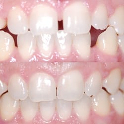 Icon Dental Smile - Invisalign