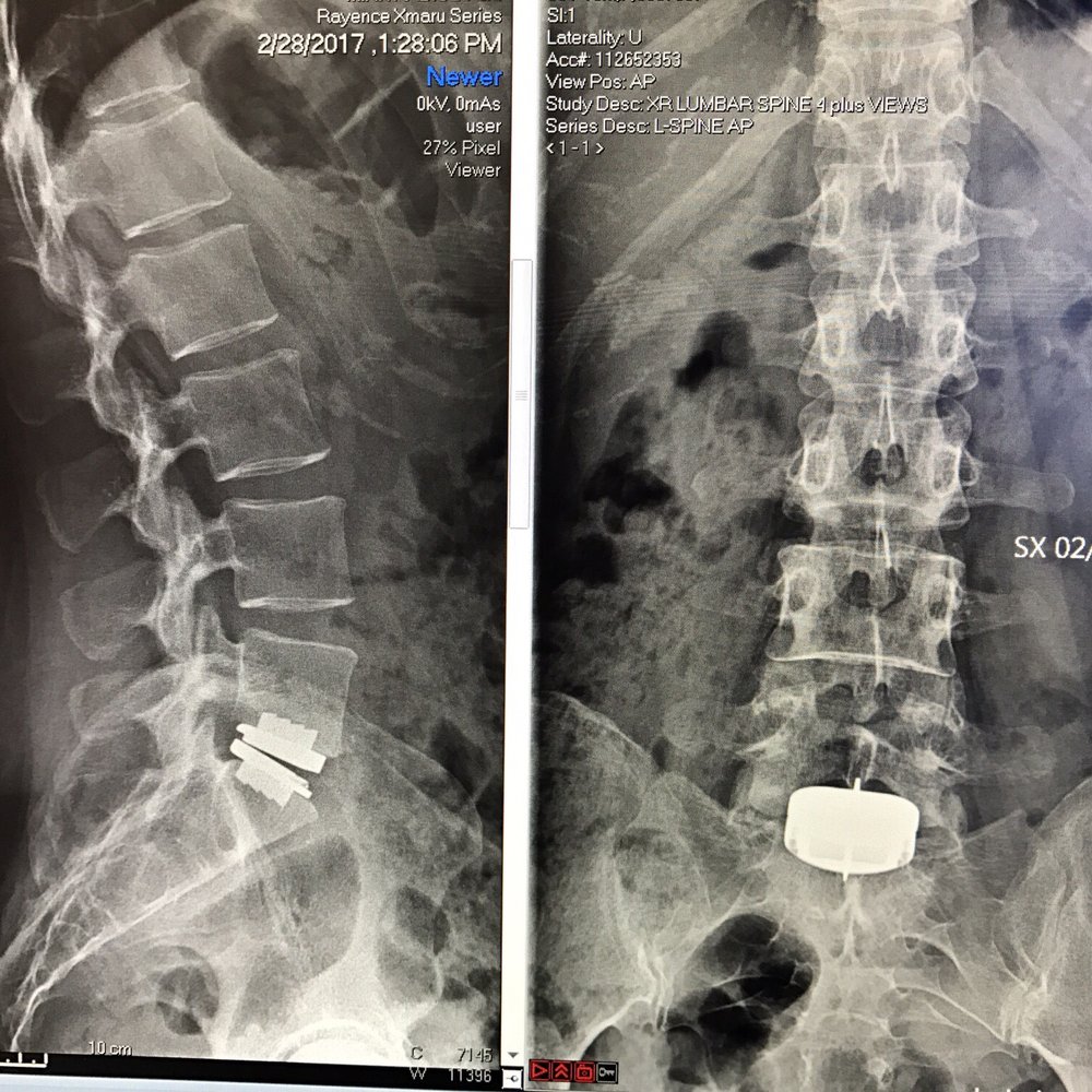 Brian Perri, DO - Cyborg spine! - Orthopedists Near Me - Los Angeles, California