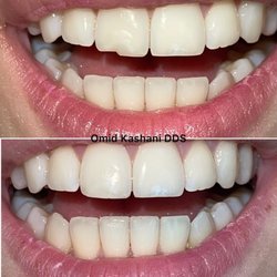 Omid R Kashani, DDS - Dental Care 2000 Plus - Bonding of a chipped front tooth.