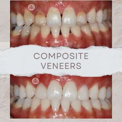 La Jolla Cosmetic Dentistry and Orthodontics - Composite Veneers