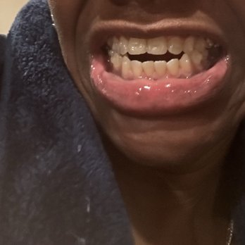 Michael Wollock, DMD- Dentistry At Suburban Square - Tooth before correction with Invisalign's - Cosmetic Dentists Near Me - Ardmore, Pennsylvania Michael Wollock, DMD- Dentistry At Suburban Square - Tooth before correction with Invisalign's - Cosmetic Dentists Near Me - Ardmore, Pennsylvania