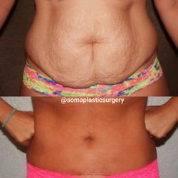 George Papanicolaou, MD - Soma Plastic Surgery - Our lovely patient had our mommy makeover procedure which includes a tummytuck and small liposuction to bring back her pre pregnancy figure.