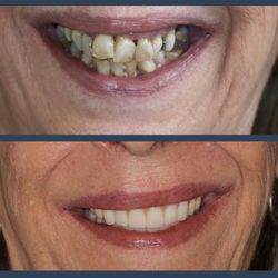 Dental Implants Miami Beach