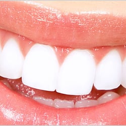 Dental Avenue - Teeth Whitening
