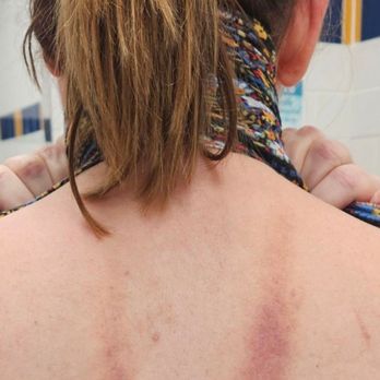 WJ Spa - My back after a "relaxing" massage - Day Spas Near Me - Medford, New York WJ Spa - My back after a "relaxing" massage - Day Spas Near Me - Medford, New York