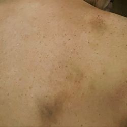 Respa Foot Spa - Bruises I obtained from a massage at Respa.