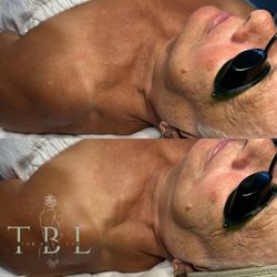 Dry, dehydrated décolleté before. Smooth, hydrated décolleté after