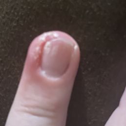 Infected finger..... Infected finger.....