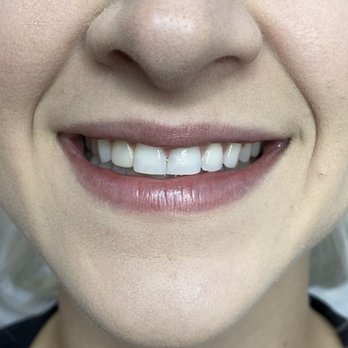 Vida Dentistry - Before - Cosmetic Dentists Near Me - Mission Viejo, California Vida Dentistry - Before - Cosmetic Dentists Near Me - Mission Viejo, California