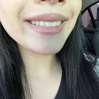 Care Orthodontics - after treatment - Orthodontists Near Me - San Jose, California Care Orthodontics - after treatment - Orthodontists Near Me - San Jose, California