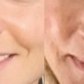 Andrew S.Frankel,MD - This photo shows how crooked my nose healed. A complete disaster. - Plastic Surgeons Near Me - Beverly Hills, California