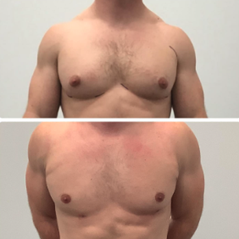 BelleSculpt - Body Contouring Near Me - Tulsa, Oklahoma