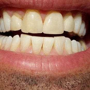 Michael A  Horvath, DDS - My old cracked receded veneers before Dr. Horvath's majic. - Cosmetic Dentists Near Me - New York, New York
