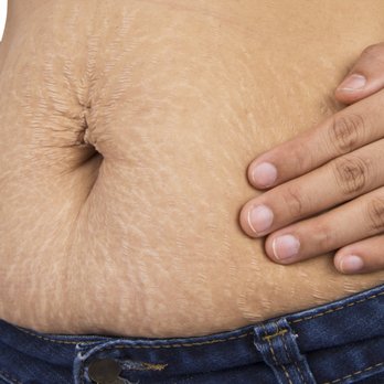 Slender Body & Mind - Tighten Loose Skin! - Body Contouring Near Me - Seattle, Washington Slender Body & Mind - Tighten Loose Skin! - Body Contouring Near Me - Seattle, Washington