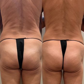 Unique Spa House - LPG Endermologie 6 treatments result - Medical Spas Near Me - San Diego, California Unique Spa House - LPG Endermologie 6 treatments result - Medical Spas Near Me - San Diego, California