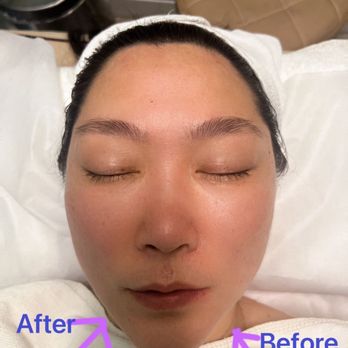 Miss Beauty - Before and after comparison pictures, I was very surprised - Skin Care Near Me - Chino Hills, California Miss Beauty - Before and after comparison pictures, I was very surprised - Skin Care Near Me - Chino Hills, California