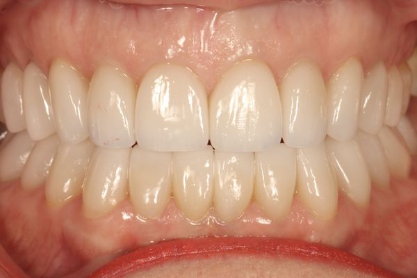 Smile Design Before & After Results - Smile makeover results using cosmetic veneer restorations.