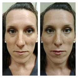 Learn2Lose - Charlotte - Restylane Lip Enhancement - Very Subtle
