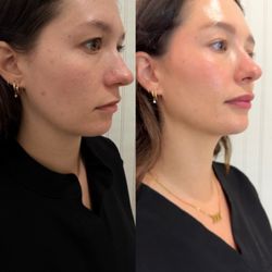 Nurse Jess Injects Injectables & Aesthetics Lounge - Juvederm Volux for sharp or subtle jawline definition.
