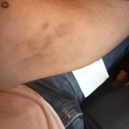 Bruising Bruising