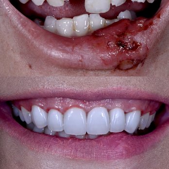 Jeremy Heldt, DDS - How i came to Dr Heldt June 7,2020 versus April 5, 2021 - General Dentistry Near Me - Newport Beach, California Jeremy Heldt, DDS - How i came to Dr Heldt June 7,2020 versus April 5, 2021 - General Dentistry Near Me - Newport Beach, California