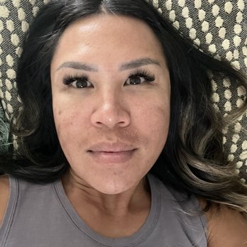 Aesthetiks - Day 4 of microneedling prp results - Medical Spas Near Me - Riverside, California Aesthetiks - Day 4 of microneedling prp results - Medical Spas Near Me - Riverside, California