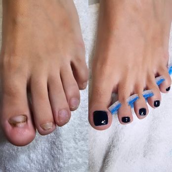 Advanced Ankle and Foot Center - KeryFlex medical grade resin reconstruction. - Podiatrists Near Me - Columbus, Georgia Advanced Ankle and Foot Center - KeryFlex medical grade resin reconstruction. - Podiatrists Near Me - Columbus, Georgia