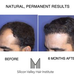 Silicon Valley Hair Institute - Natural hairlines