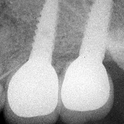 Yelena Vaysman, DDS - X-Ray of upper jaw implants with crowns.  Implants placed by Dr. Yuly Gertsberg