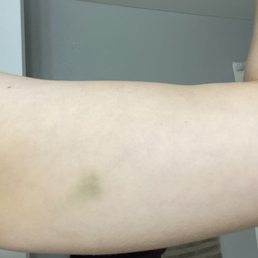 Bruises from massage Bruises from massage