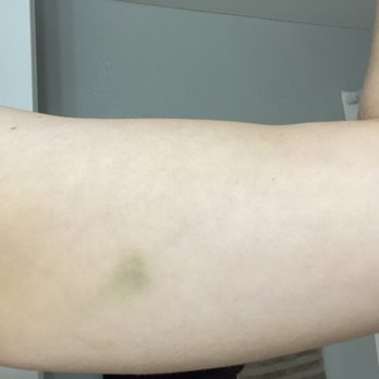 A+Massage - Bruises from massage - Massage Near Me - Omaha, Nebraska A+Massage - Bruises from massage - Massage Near Me - Omaha, Nebraska