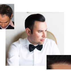 Shapiro Medical Group - Before & after FUE hair transplant surgery procedure performed by Shapiro Medical Group physicians in Bloomington / Minneapolis, MN.
