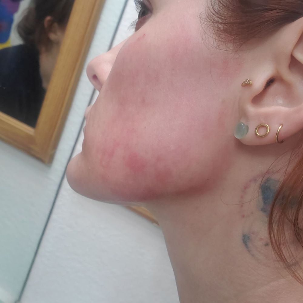 Elite Medspa - Most recent photo. Just shy of 3 months healing time. - Medical Spas Near Me - Scottsdale, Arizona
