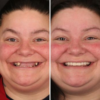 Britely Dentures + Implants Studio - Final result of full mouth dental implants! - Oral Surgeons Near Me - Golden Valley, Minnesota