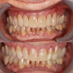 May Y.  Huang, DDS - Evergreen Dental Group - Porcelain veneers smile make over.