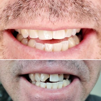 Oliver Cruz, DDS - We restored our patient's beautiful smile with implants and crowns. - Cosmetic Dentists Near Me - Los Alamitos, California Oliver Cruz, DDS - We restored our patient's beautiful smile with implants and crowns. - Cosmetic Dentists Near Me - Los Alamitos, California
