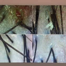 Zen Scalp Spa - Follicle before&after