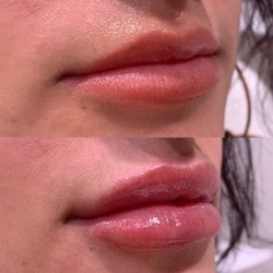 Park Ave Cosmetic Center - Roswell, GA - Best Lip Filler/ Lip Injections/ Juvederm/ Versa/Lip Flip/