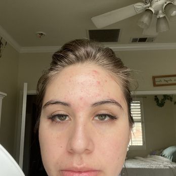 Facelogic Spa - Before Ani - Skin Care Near Me - Chino Hills, California Facelogic Spa - Before Ani - Skin Care Near Me - Chino Hills, California