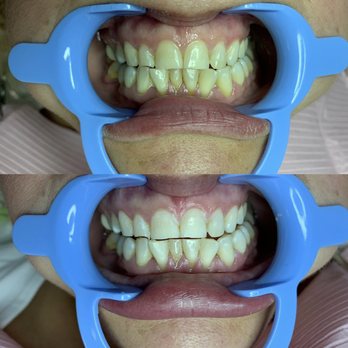 Mari & Ale - 3* 20 minute sessions took to achieve these results - Estheticians Near Me - Las Vegas, Nevada Mari & Ale - 3* 20 minute sessions took to achieve these results - Estheticians Near Me - Las Vegas, Nevada